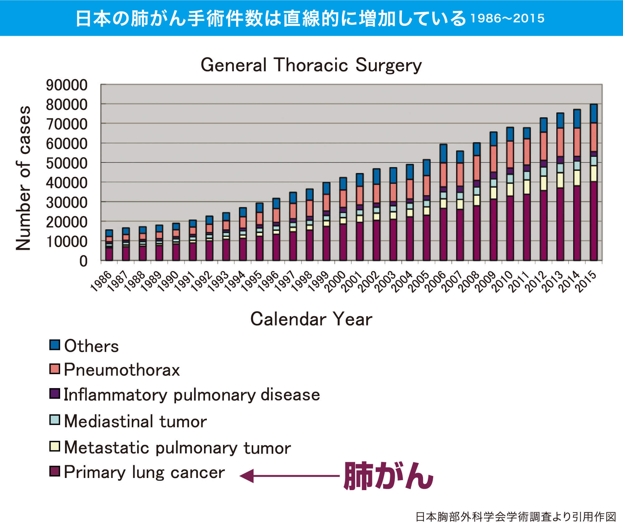 日本の肺がん手術件数は直線的に増加している