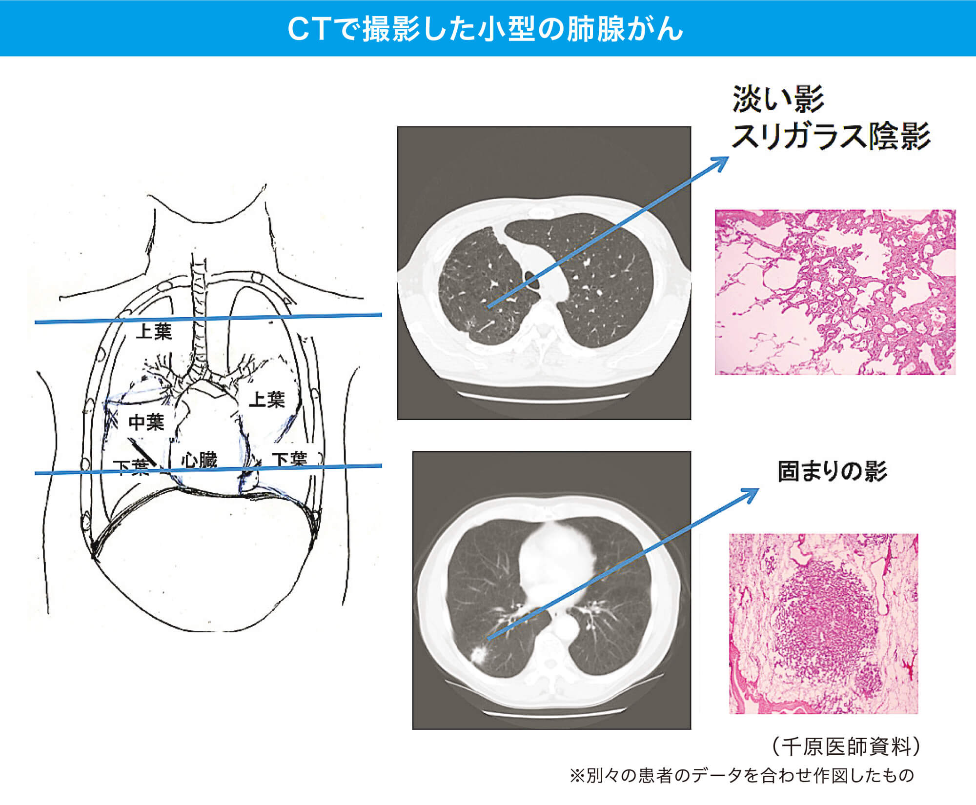 CTで撮影した小型の肺線がん