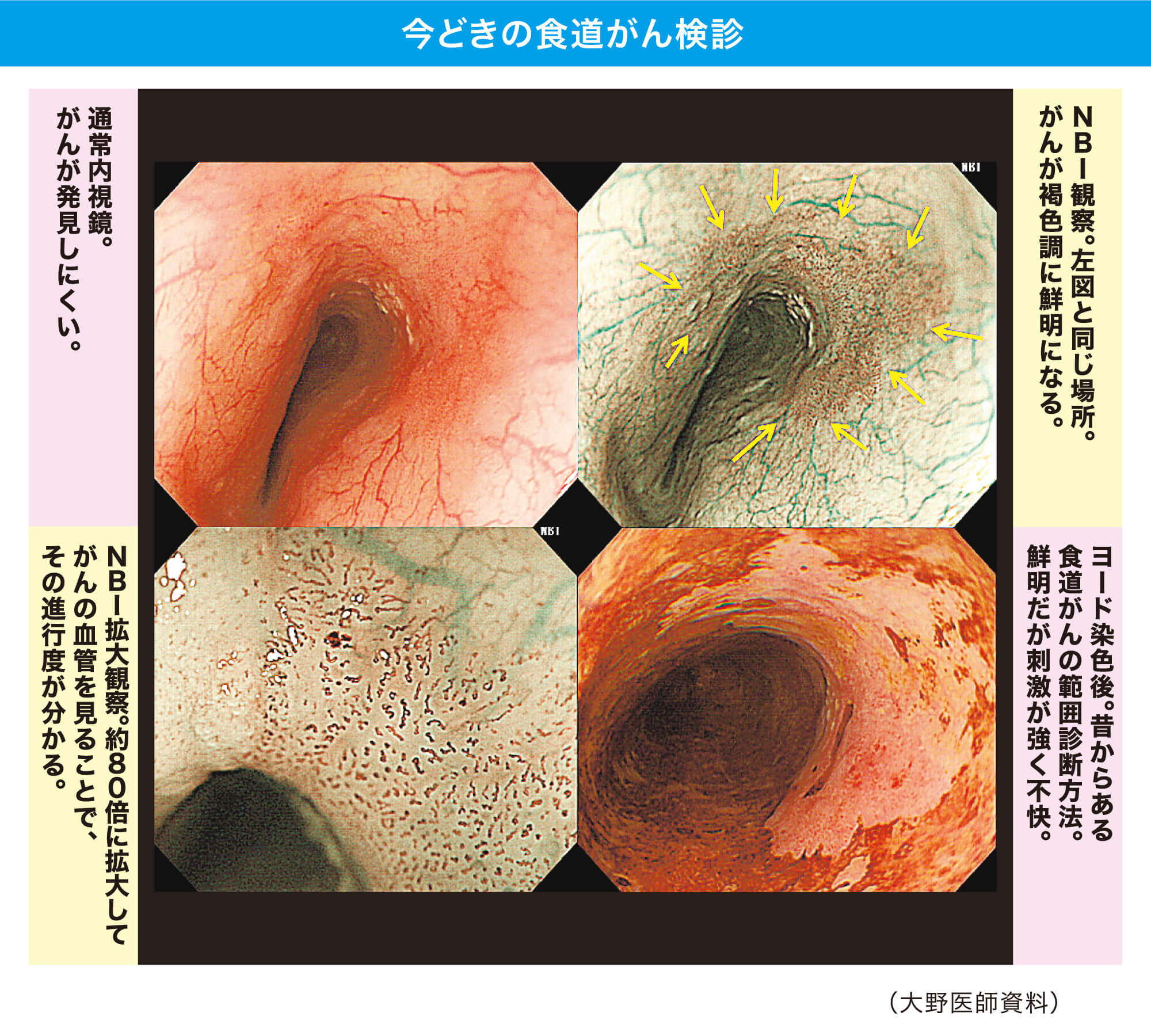 今どきの食道がん検診