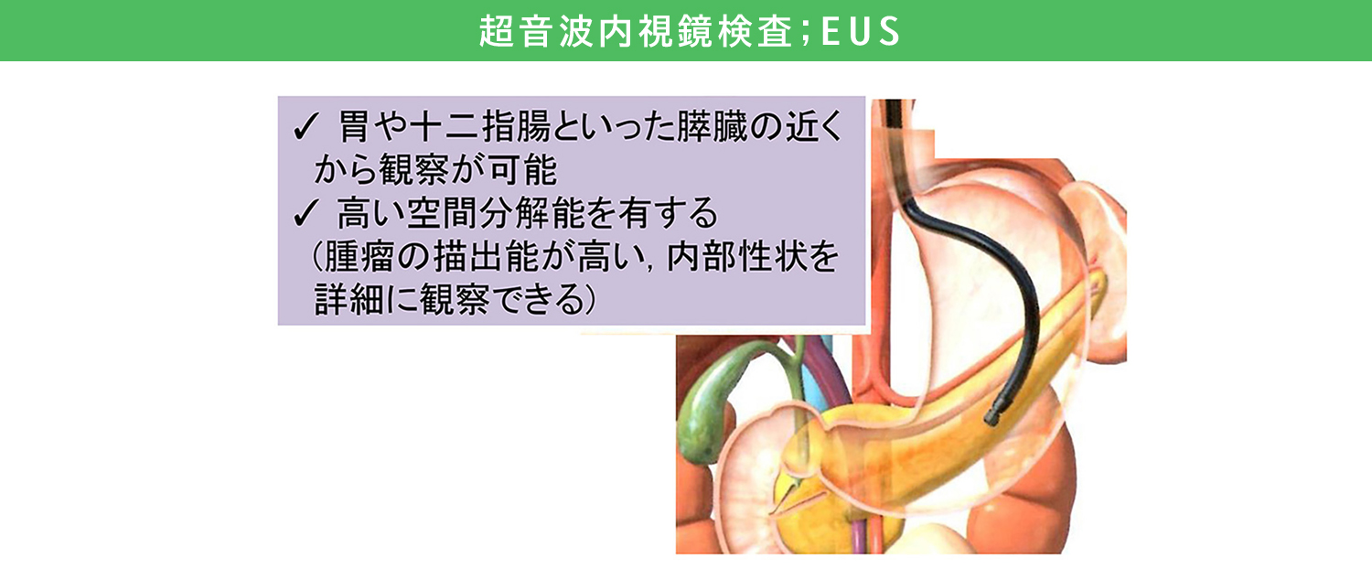 超音波内視鏡検査：EUS