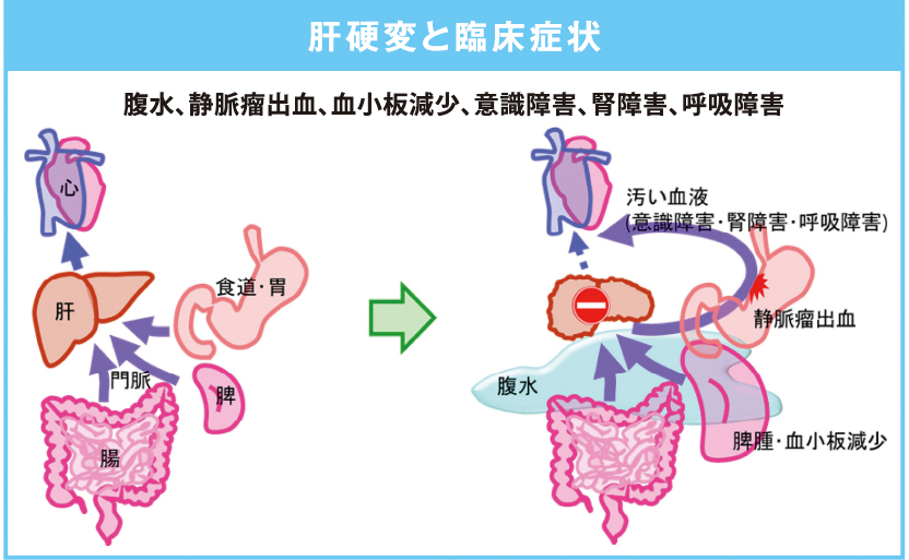 肝硬変と臨床症状